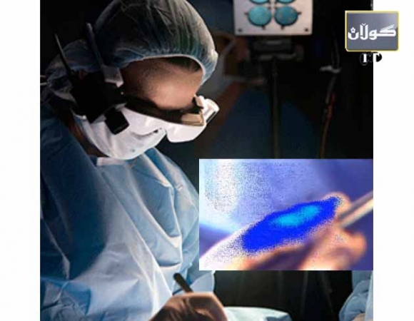 كامێرایە شێرپەنجە دیاری دەكات